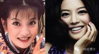 为什么明星网红牙白,如何拥有迷人笑容
